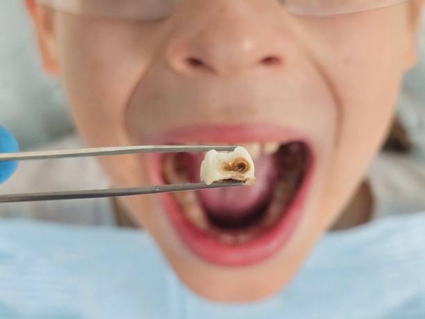Best Knocked-Out Tooth Emergency  in Sparta, IL